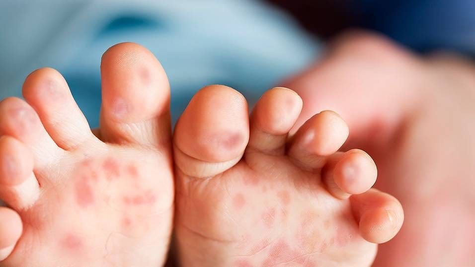 Cảnh báo: Bệnh tay chân miệng và sốt xuất huyết gia tăng ở Đà Nẵng