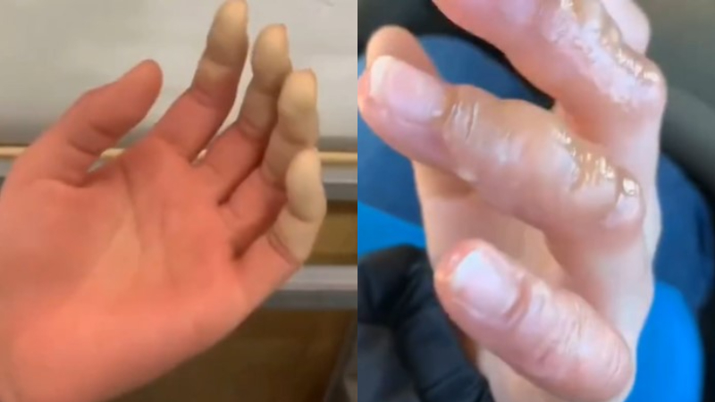 Chạy bộ trong thời tiết âm 18 độ, ngón tay cô gái Trung Quốc có nguy cơ bị cắt cụt